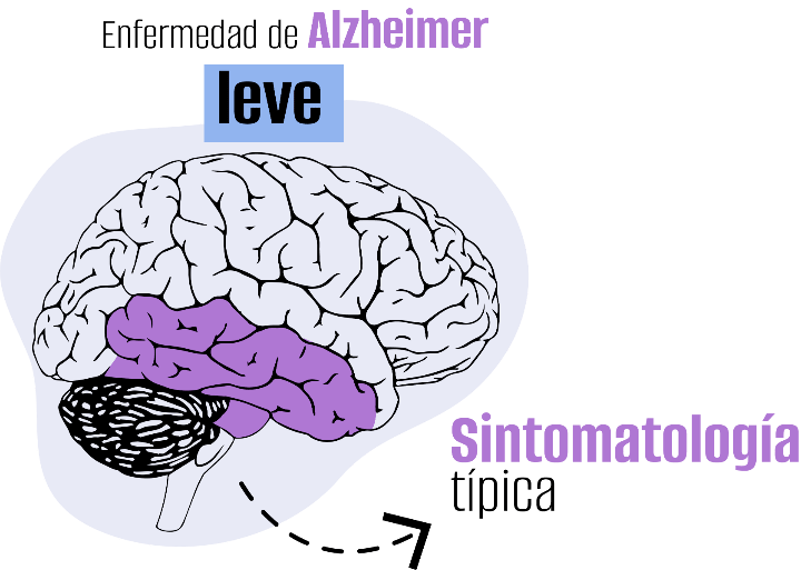 Fases del Alzhéimer Roche Pacientes